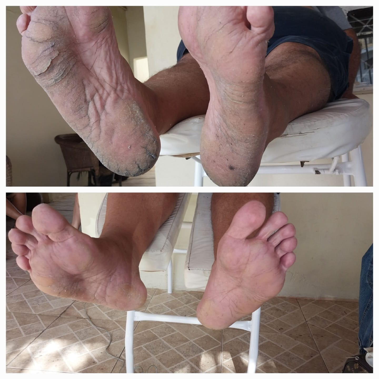 Antes e depois de tratamento de rachaduras nos pés