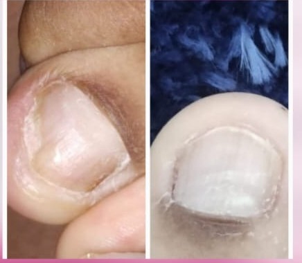 Antes e depois de tratamento de unha