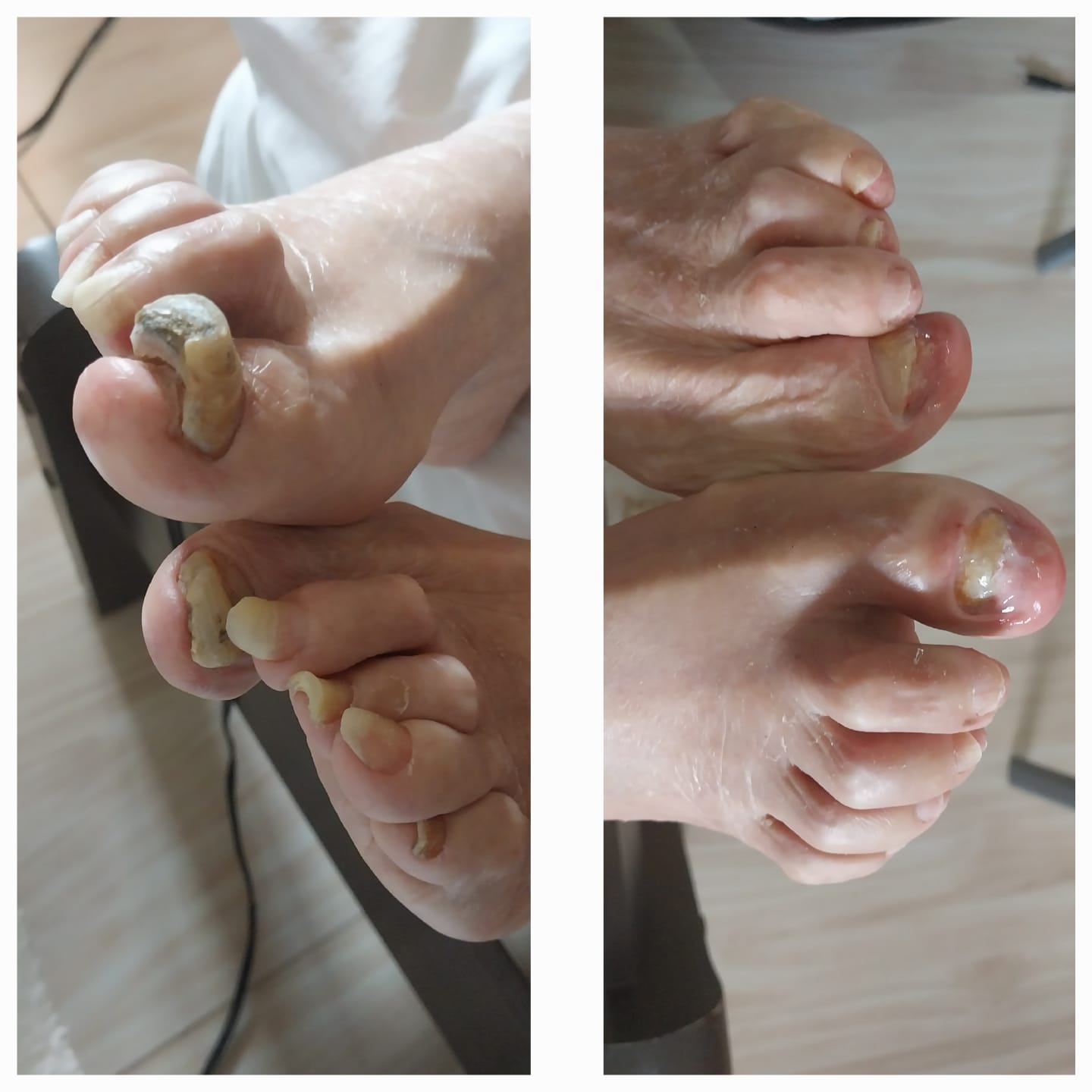 Antes e depois de cuidado em unhas dos pés