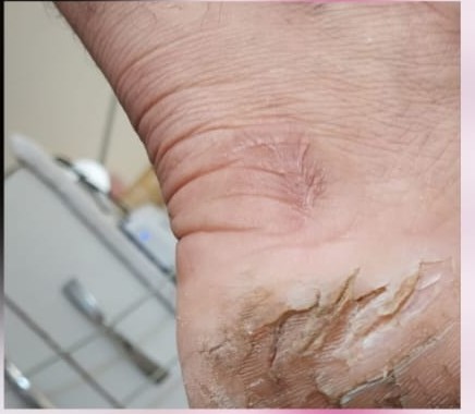 Cuidado de fissuras e pele áspera no pé