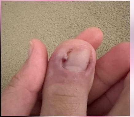 Cuidado de unha encravada realizado pela Josy Podóloga
